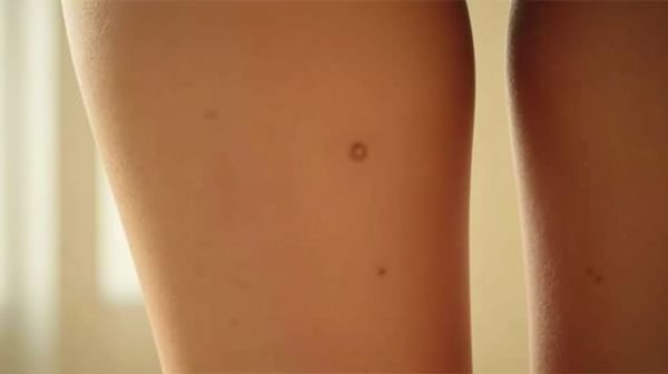 La cryolipolyse, un traitement efficace contre les amas graisseux